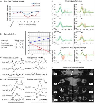 Case Report: Preservation of Otolithic Function After Triple Semicircular Canal Occlusion in a Patient With Intractable Ménière Disease